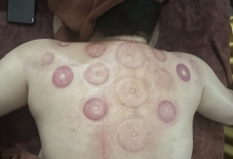 Giác Hơi & Trượt Giác Dưỡng Sinh