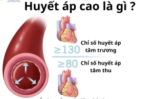 Cao huyết áp: Triệu chứng, nguyên nhân và cách điều trị