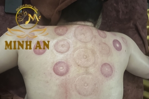 Giác Hơi & Trượt Giác Dưỡng Sinh