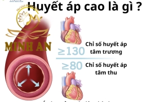 Cao huyết áp: Triệu chứng, nguyên nhân và cách điều trị