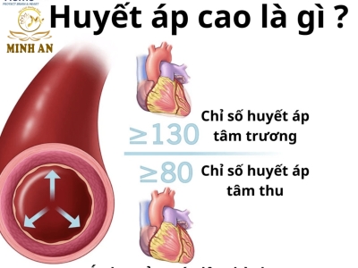 Cao huyết áp: Triệu chứng, nguyên nhân và cách điều trị